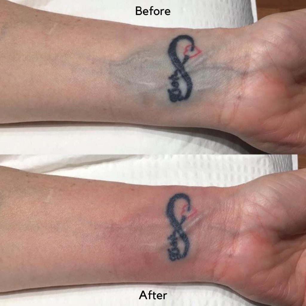 Tattoo Blowout: What Is It, and What Can I Do? - Psycho Tats